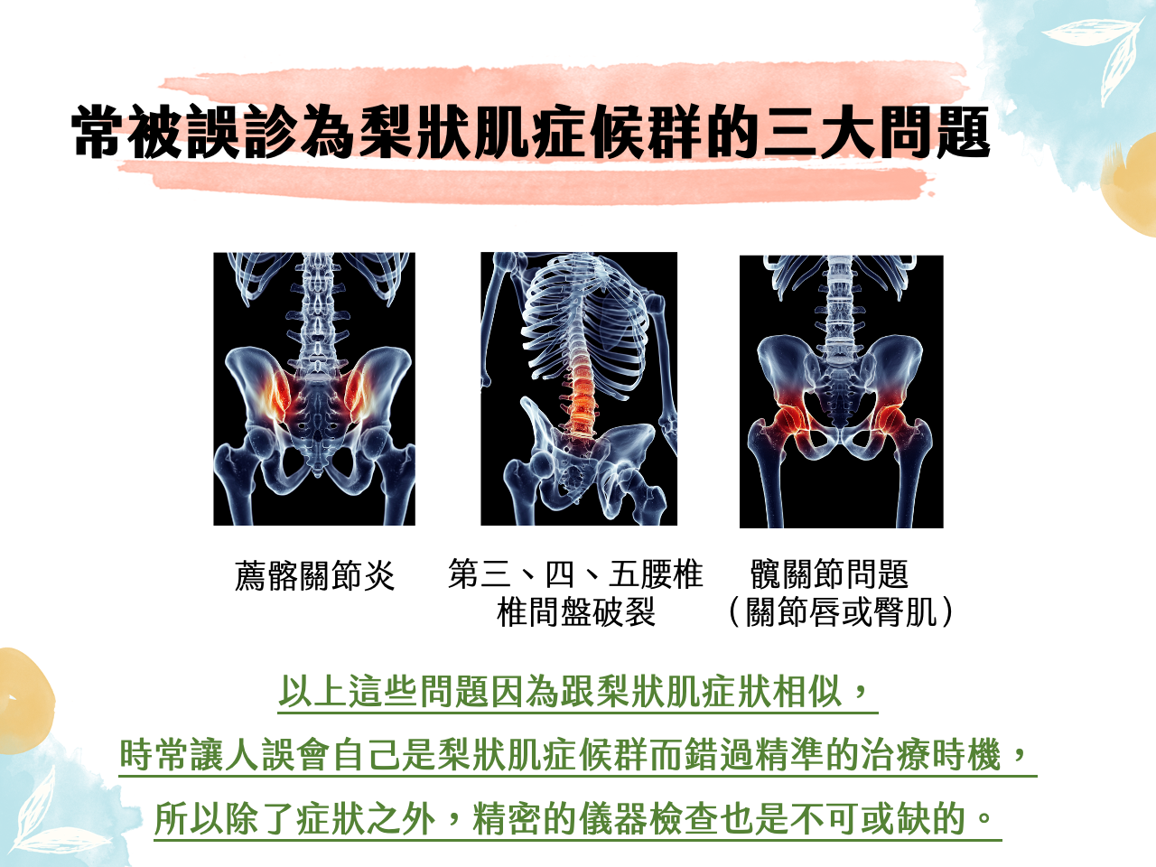 常被誤診梨狀肌的三大原因