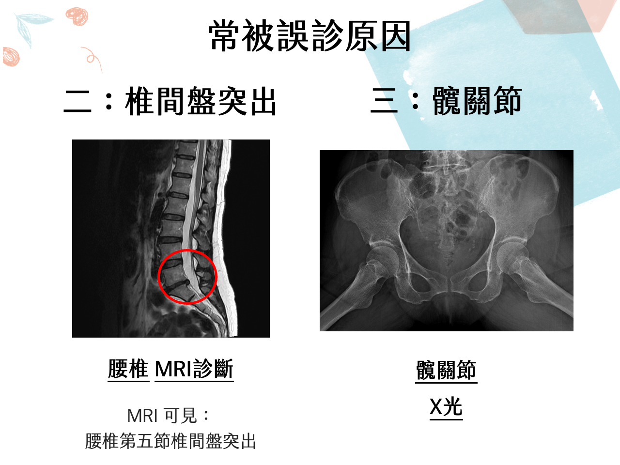 原因二：椎間盤問題易被誤診為梨狀肌