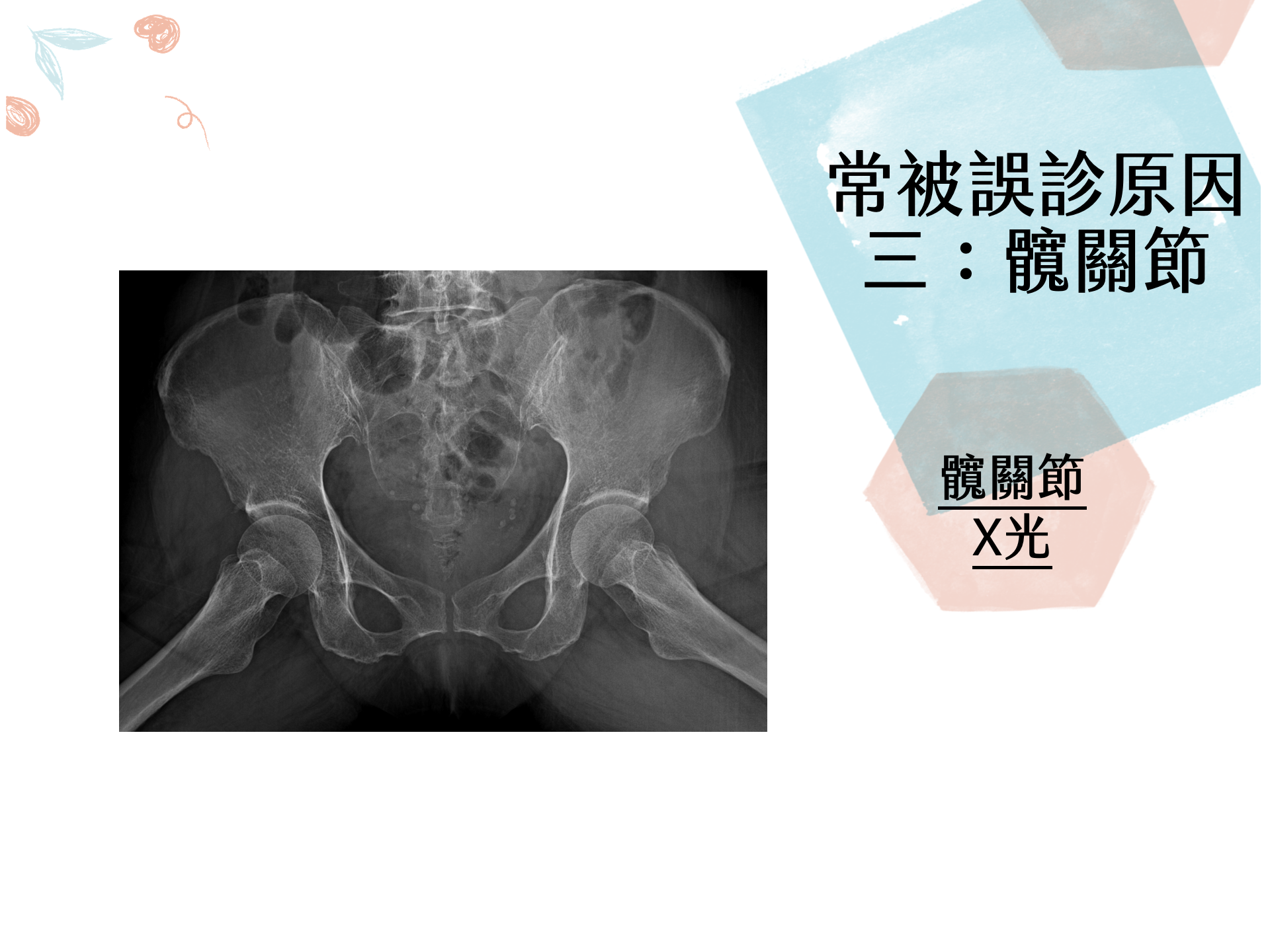原因三：髖關節疾病易被誤診為梨狀肌