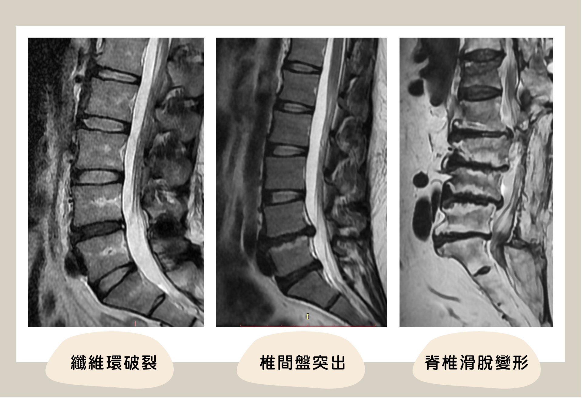 椎間盤核磁共振檢查，可能有椎間盤破裂、椎間盤突出、滑脫變形等