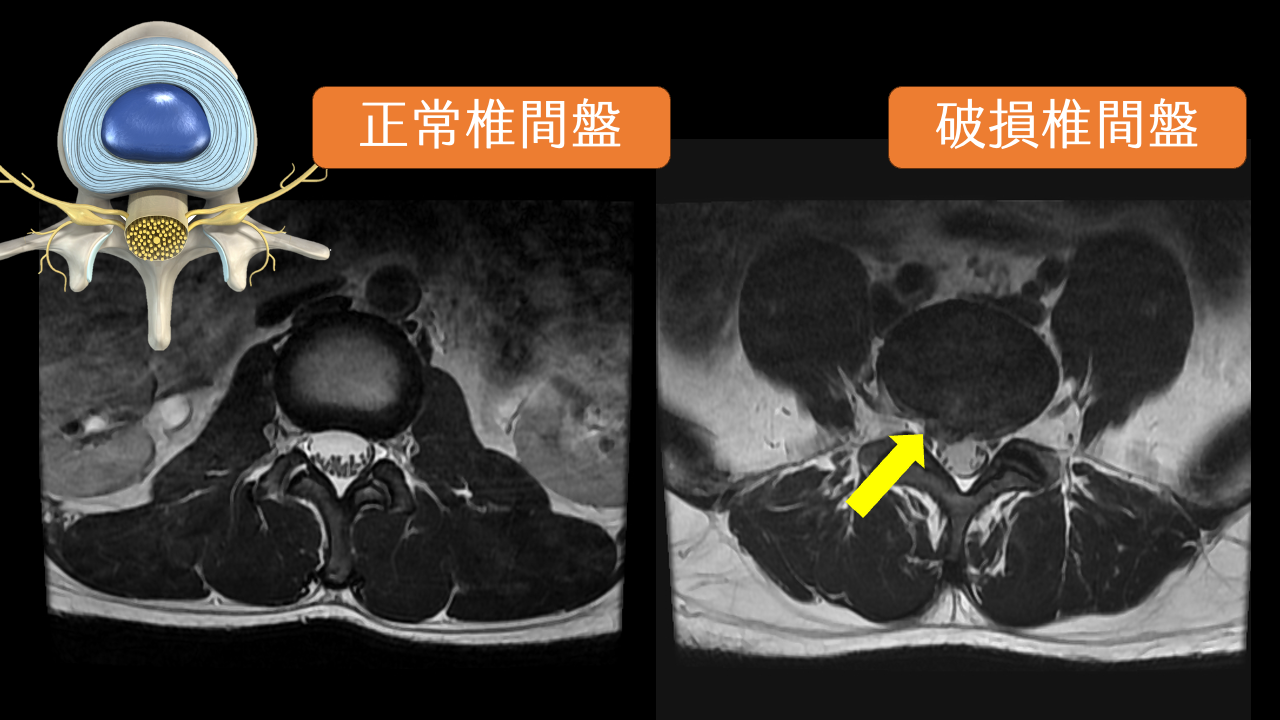 椎間盤破裂影像診斷
