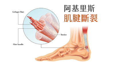 阿基里斯肌腱撕裂傷，醫生說不用開刀，卻一直治不好該怎麼辦？
